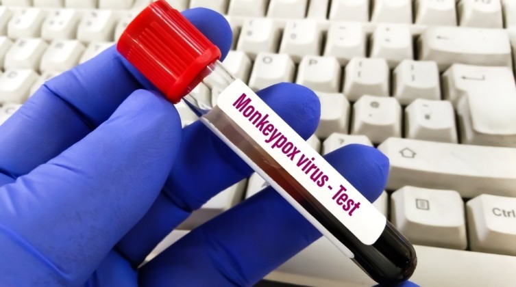 الصحة الباكستانية تعلن تسجيل أول إصابة بفيروس جدري القرود