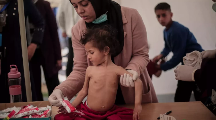 4 شهداء بينهم طفلان بسبب سوء التغذية في غزة
