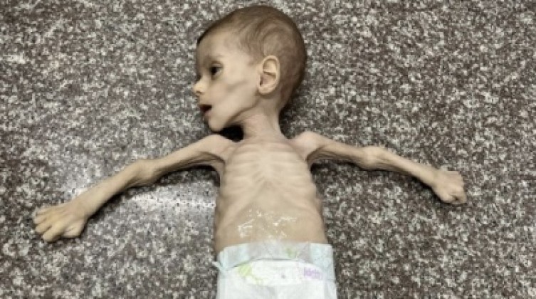 الصحة تعلن عن 8 وفيات جديدة بالمجاعة في غزة