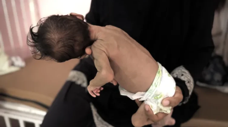5 وفيات في غزة نتيجة سوء التغذية خلال 24 ساعة
