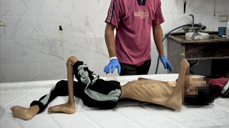 الصحة: 3 حالات وفاة جديدة نتيجة سوء التغذية بغزة