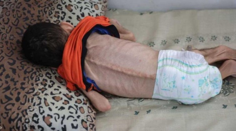 الصحة بغزة: حالتي وفاة جديدتين بسبب المجاعة وسوء التغذية