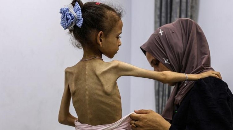4 وفيات نتيجة المجاعة وسوء التغذية بغزة خلال 24 ساعة