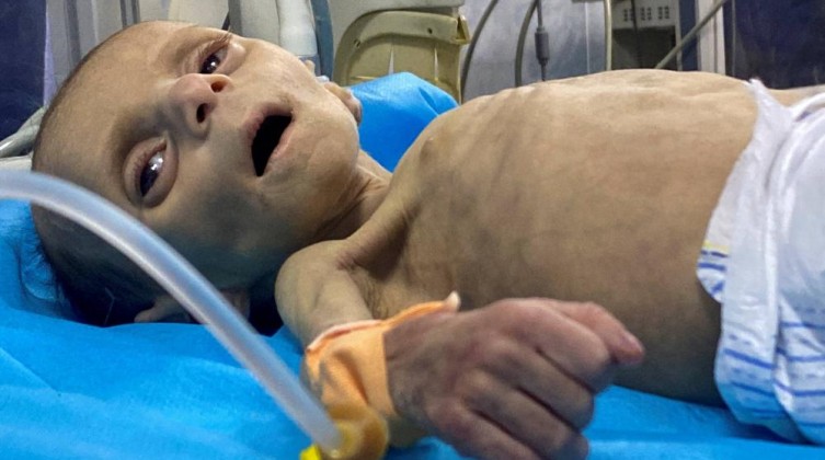 الصحة: 5 وفيات جديدة في غزة جراء المجاعة وسوء التغذية