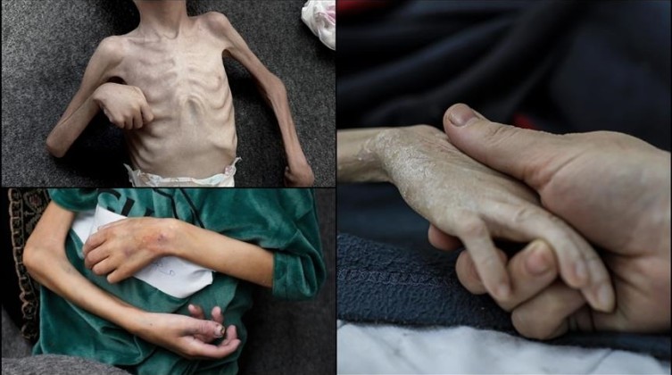 8 وفيات جديدة في غزة بسبب المجاعة وسوء التغذية