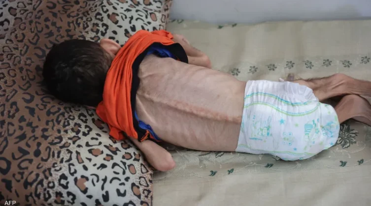 13 حالة وفاة نتيجة المجاعة بغزة خلال 24 ساعة