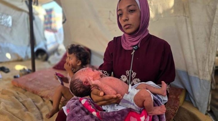 خاص بالصور: جدري الماء يحاصر رضيعة داخل خيمة نزوح بخان يونس