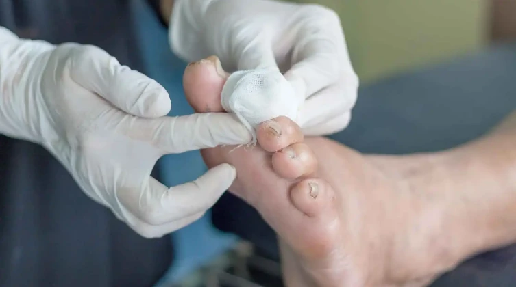 دراسة تكشف مفاجأة عن دور الجهاز المناعي في جروح مرضى السكري